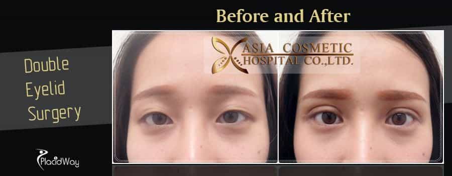 Before and After Double Eyelid Surgery in Thailand